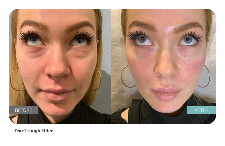 Before and after treatment result — Dr. Lanna, LC Medical Aesthetics NYC